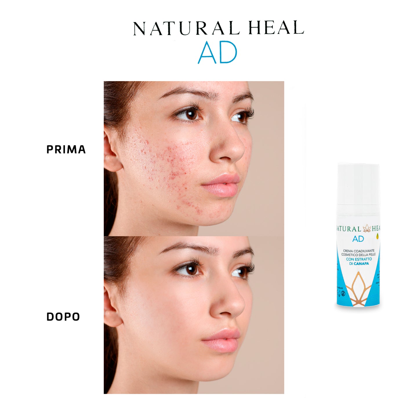 Natural Heal AD Crema Brufoli Viso – Trattamento Naturale per Imperfezioni Cutanee | La Canapa Sativa